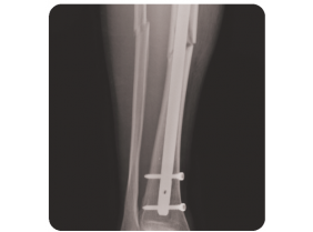 Chấn thương chân và đầu gối